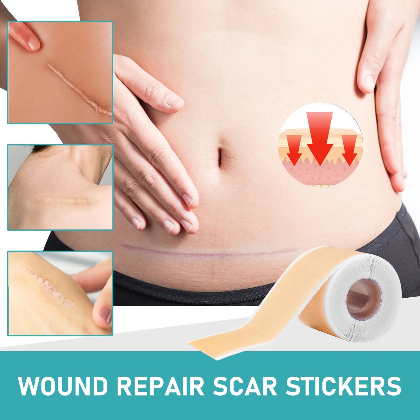 Effective Medical Grade Silicone Scar Sheet (4cm x1.5m roll)